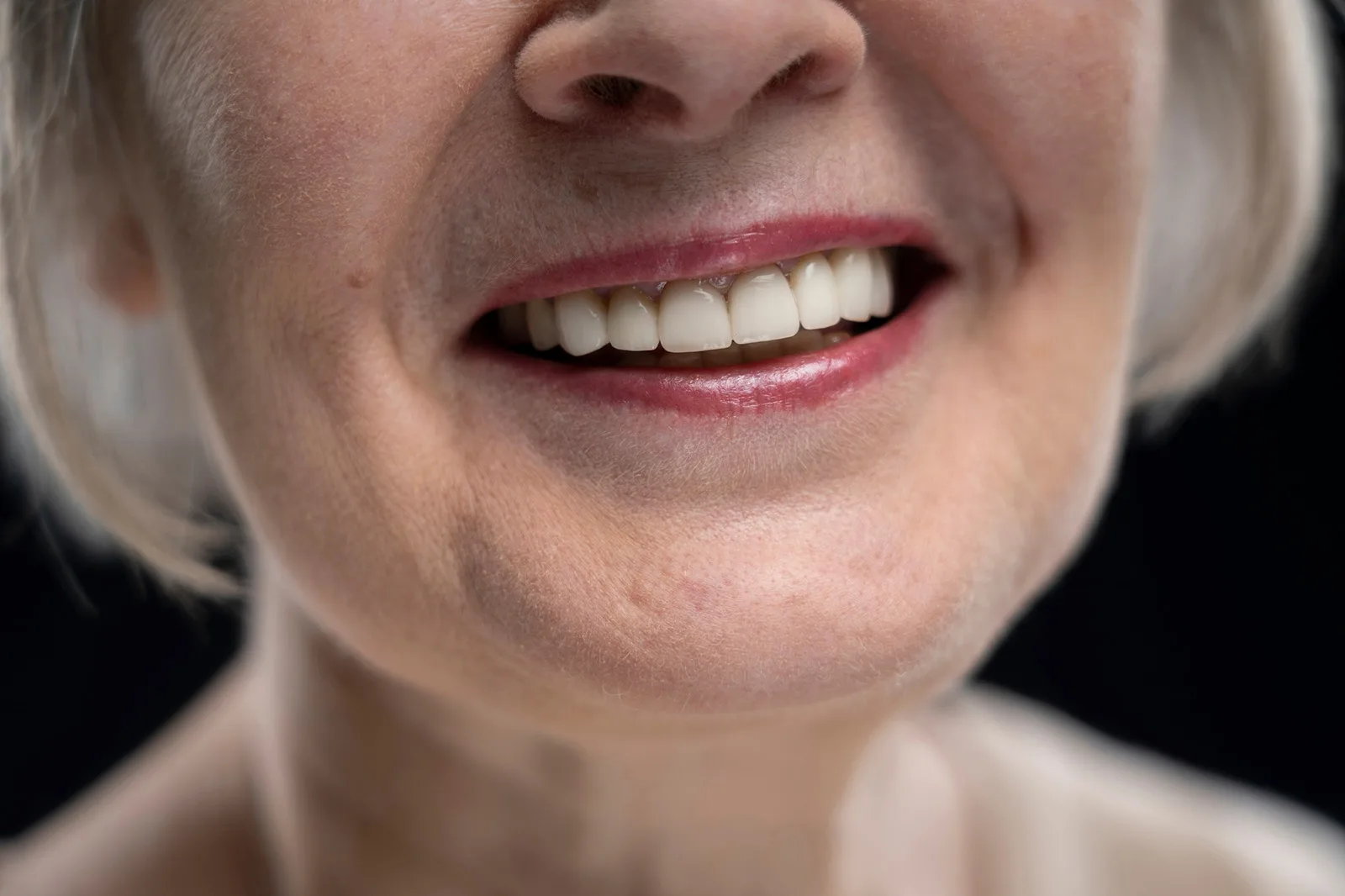 Nahaufnahme eines schönen Lächelns mit festem Zahnersatz durch Implantate im Oberkiefer